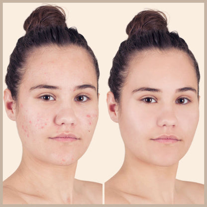 Before and After effect of Oplenza Opulent Concealer Palette - best concealer palette for red dots
